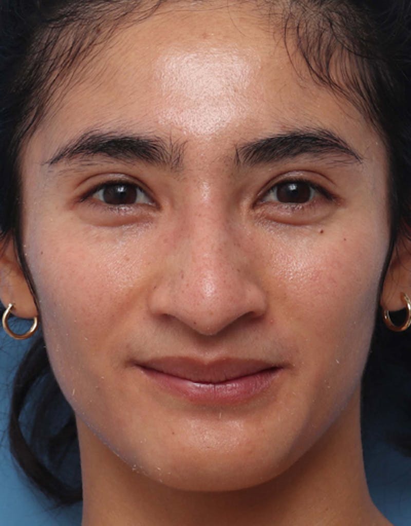Rhinoplasty  Before & After Gallery - Patient 194204 - Image 3