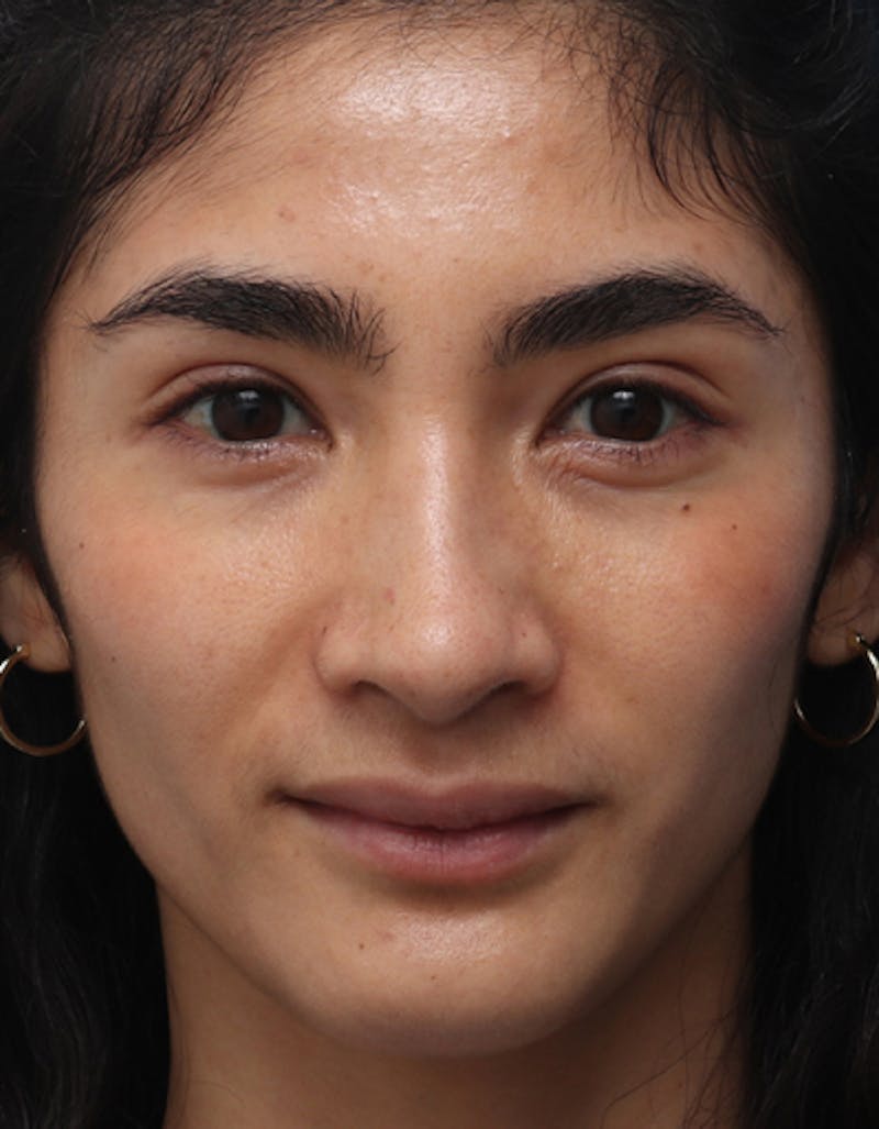 Rhinoplasty  Before & After Gallery - Patient 194204 - Image 4