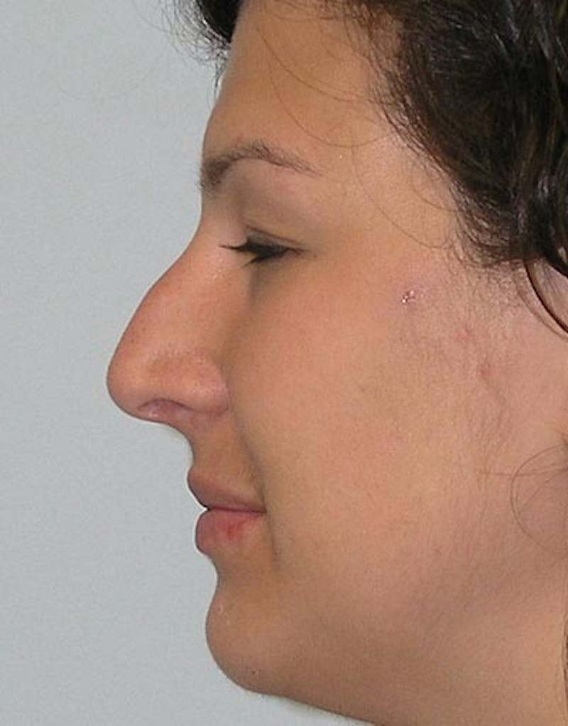 Rhinoplasty Before & After Gallery - Patient 120738 - Image 1