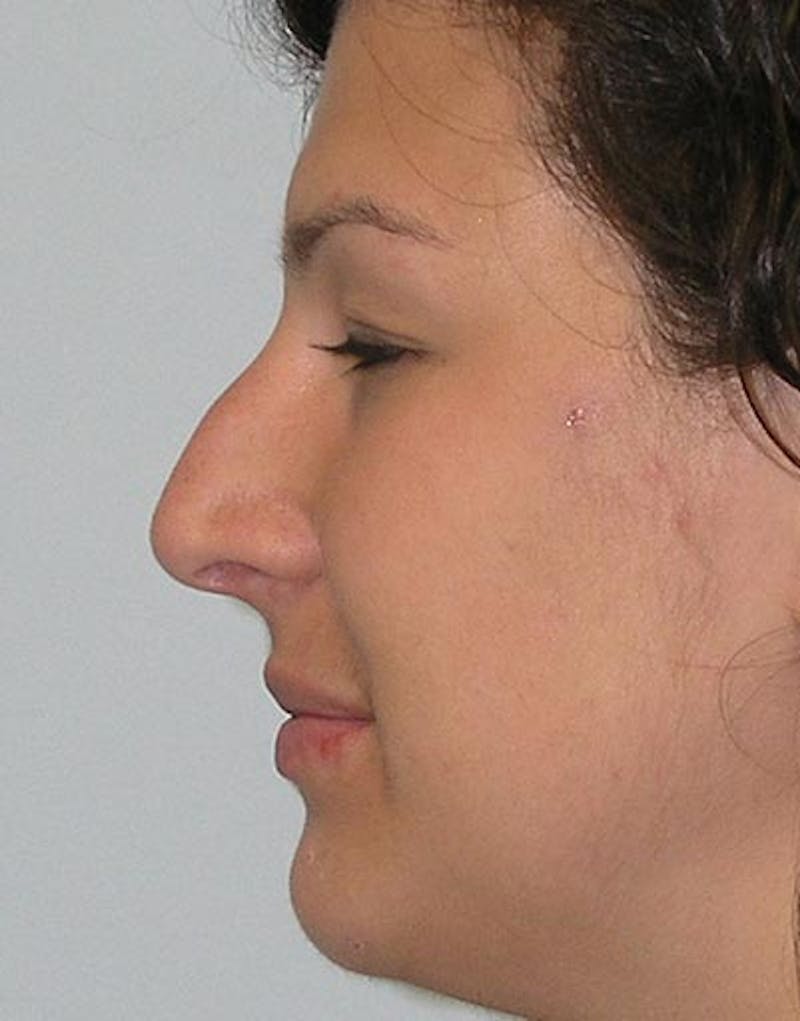 Patient bIEVkIhmSqWl-bRE4dOkjw - Rhinoplasty Before & After Photos