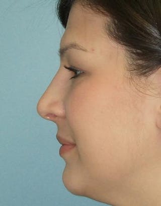 Rhinoplasty Before & After Gallery - Patient 422409 - Image 2