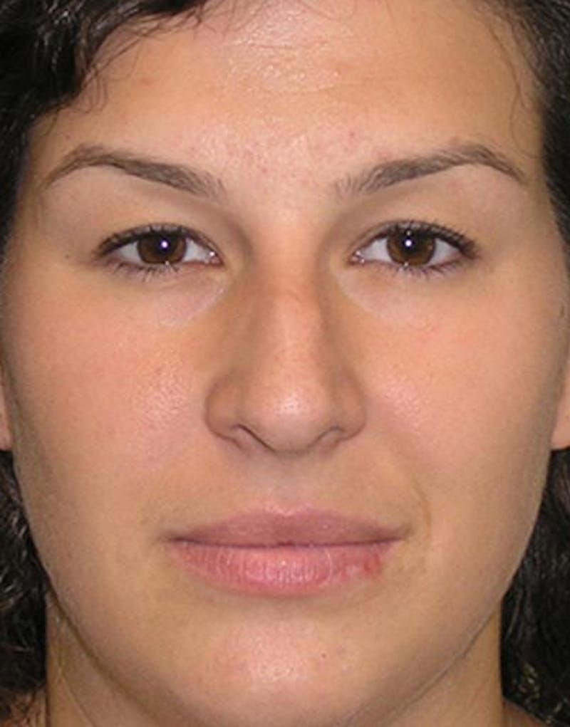 Rhinoplasty Before & After Gallery - Patient 120738 - Image 3