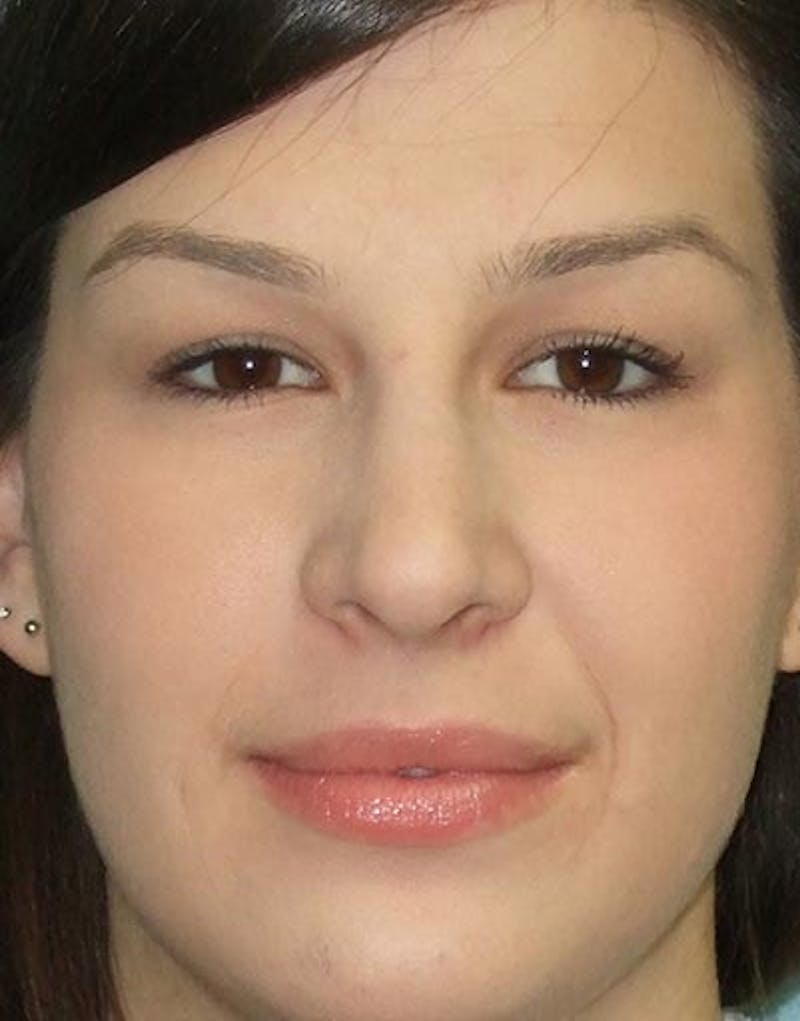 Rhinoplasty Before & After Gallery - Patient 120738 - Image 4