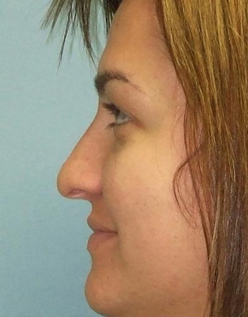 Rhinoplasty Before & After Gallery - Patient 855894 - Image 1