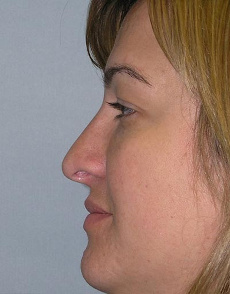 Rhinoplasty Before & After Gallery - Patient 855894 - Image 2