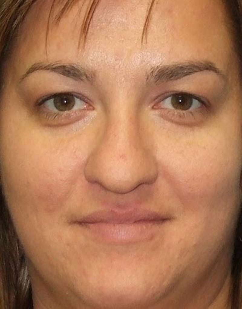 Rhinoplasty Before & After Gallery - Patient 855894 - Image 3