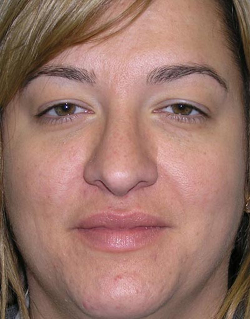 Rhinoplasty Before & After Gallery - Patient 855894 - Image 4