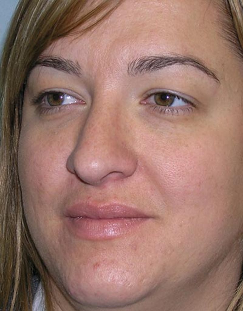 Rhinoplasty Before & After Gallery - Patient 855894 - Image 6