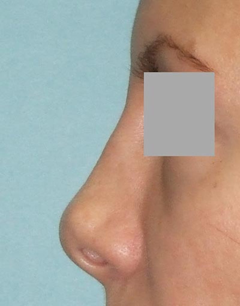 Patient VTJCde8tTdiOPf8jep8B4A - Rhinoplasty Before & After Photos
