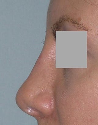Rhinoplasty Before & After Gallery - Patient 402634 - Image 2