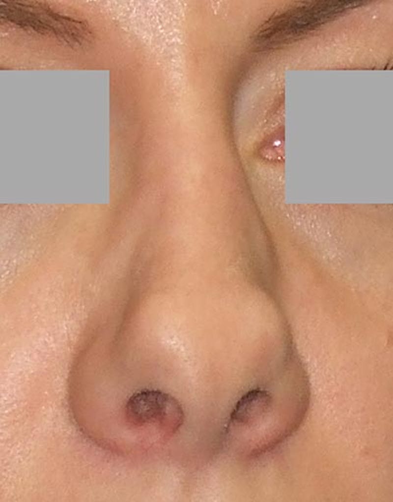 Rhinoplasty Before & After Gallery - Patient 133506 - Image 3