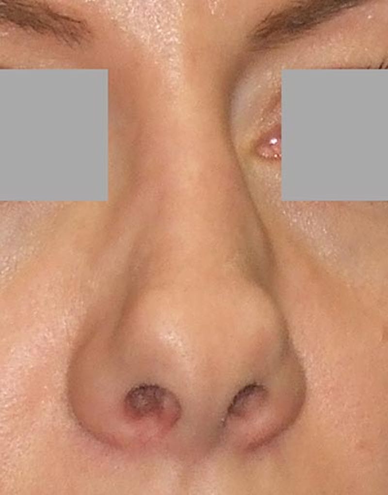 Rhinoplasty  Before & After Gallery - Patient 402634 - Image 3