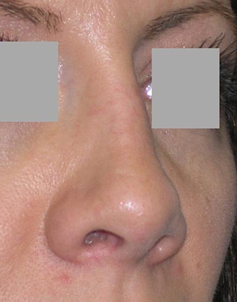 Rhinoplasty Before & After Gallery - Patient 133506 - Image 4