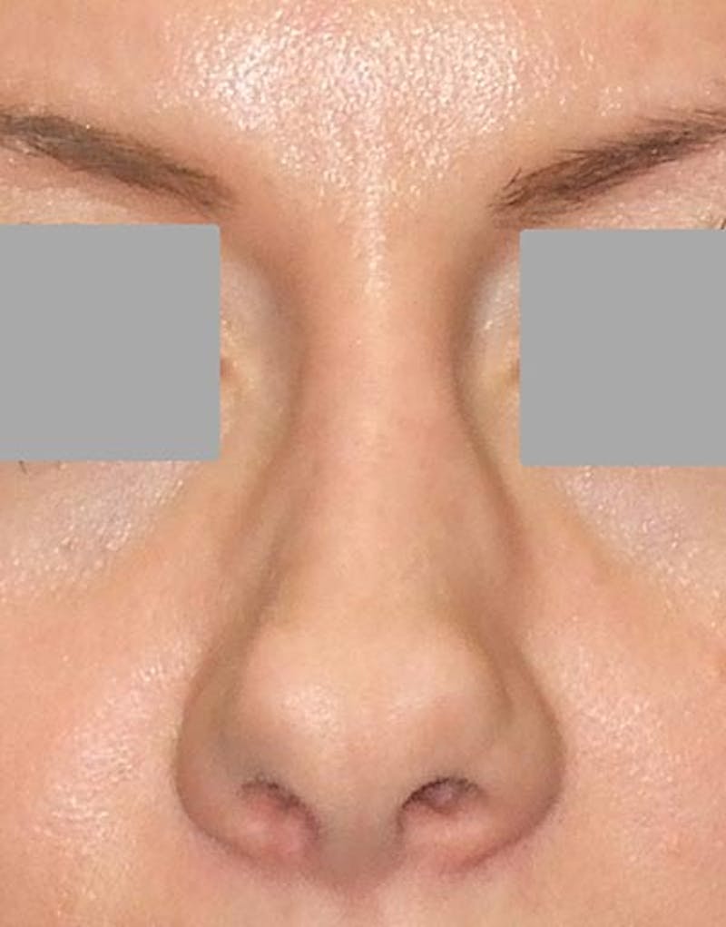 Rhinoplasty Before & After Gallery - Patient 133506 - Image 5