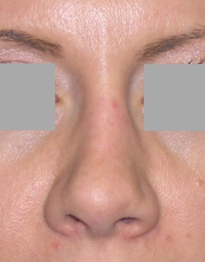 Rhinoplasty Before & After Gallery - Patient 133506 - Image 6