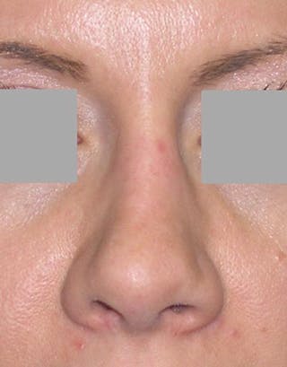 Rhinoplasty Before & After Gallery - Patient 402634 - Image 6