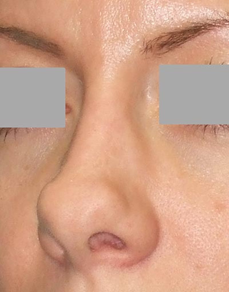 Rhinoplasty Before & After Gallery - Patient 133506 - Image 7