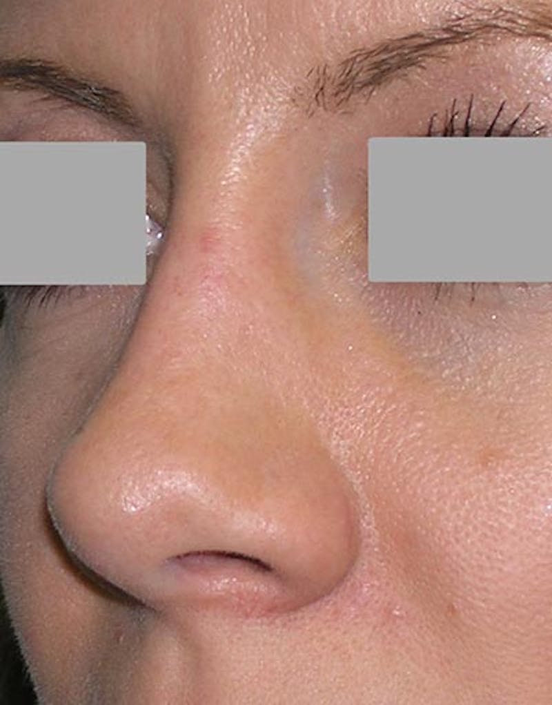 Rhinoplasty Before & After Gallery - Patient 133506 - Image 8