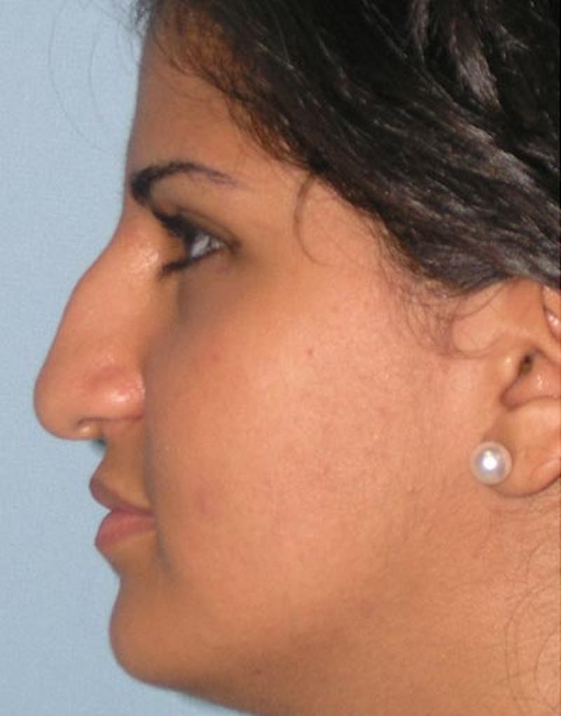 Rhinoplasty Before & After Gallery - Patient 416645 - Image 1