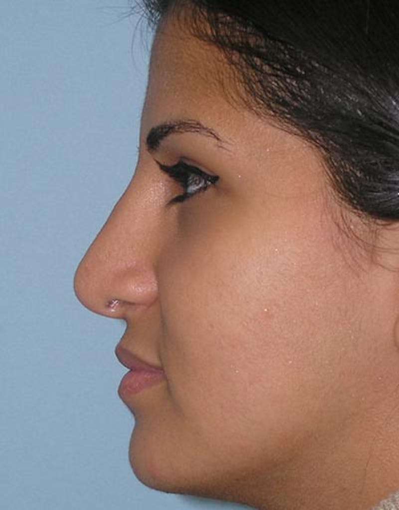 Rhinoplasty Before & After Gallery - Patient 416645 - Image 2