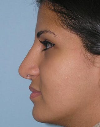 Rhinoplasty Before & After Gallery - Patient 253779 - Image 2