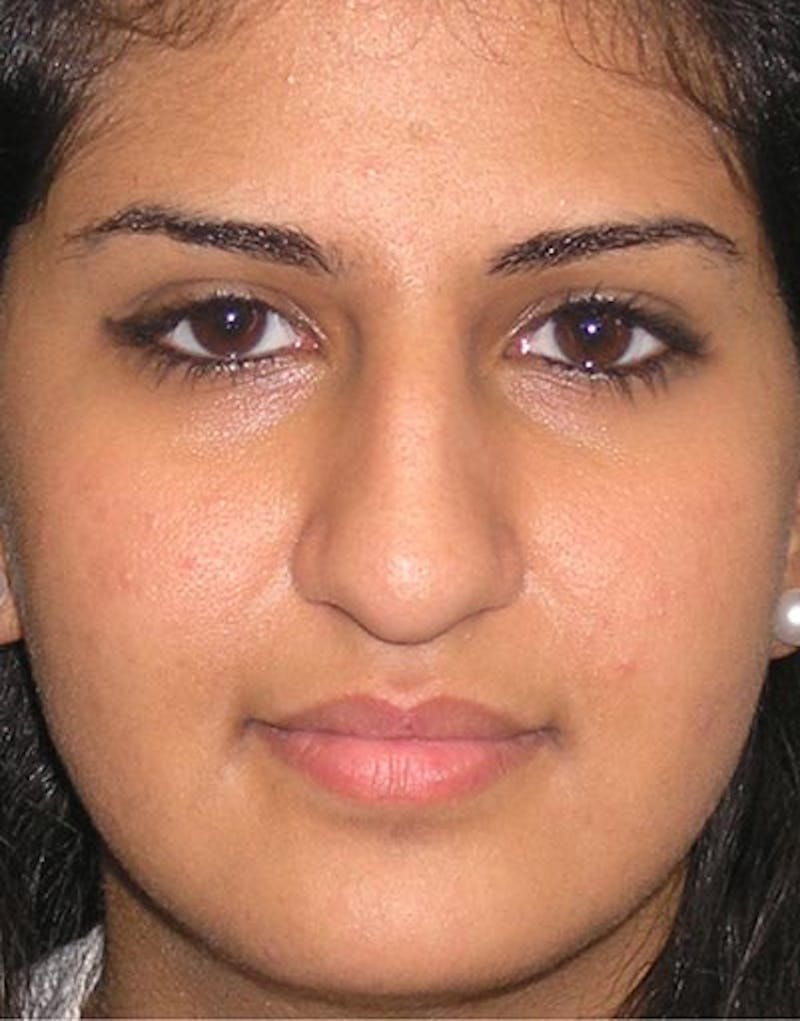 Rhinoplasty Before & After Gallery - Patient 416645 - Image 3