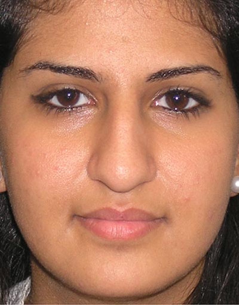 Rhinoplasty  Before & After Gallery - Patient 253779 - Image 3