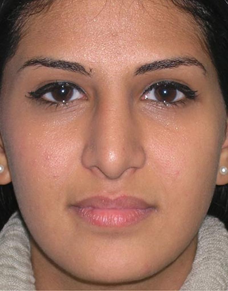 Rhinoplasty Before & After Gallery - Patient 416645 - Image 4