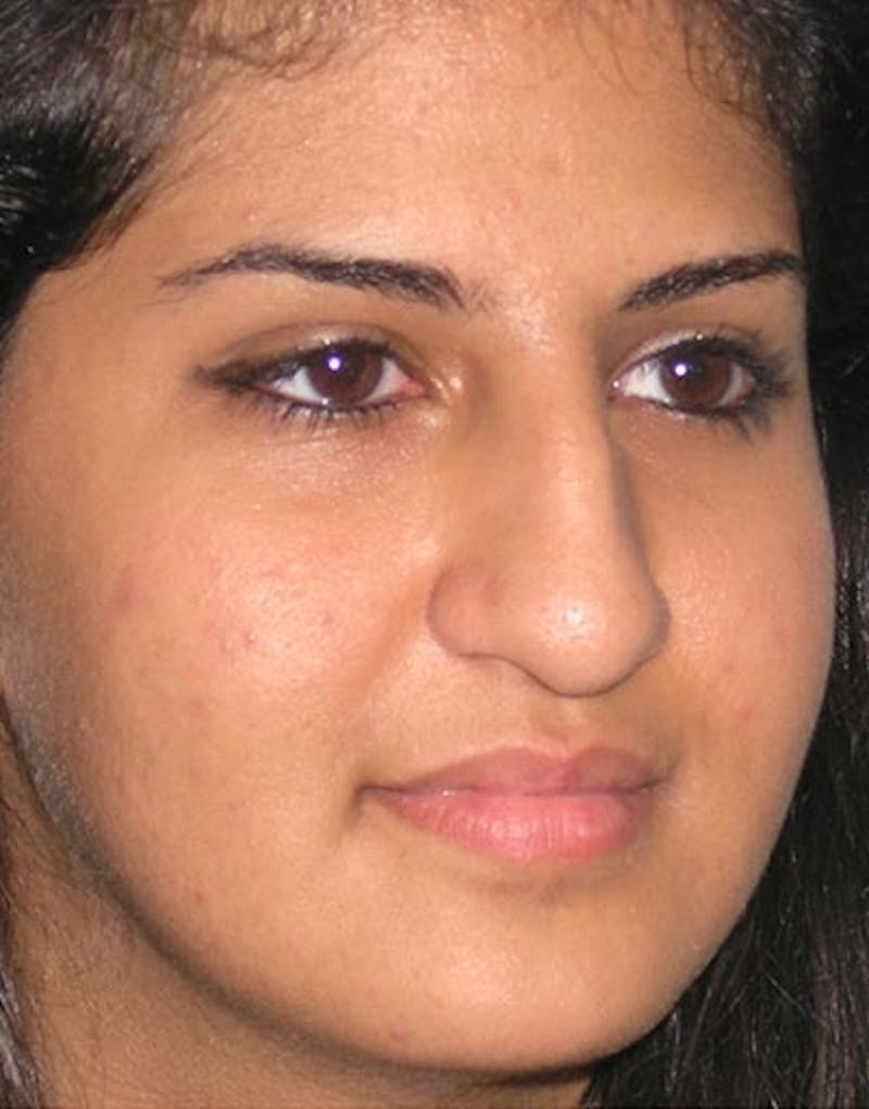 Rhinoplasty  Before & After Gallery - Patient 253779 - Image 5