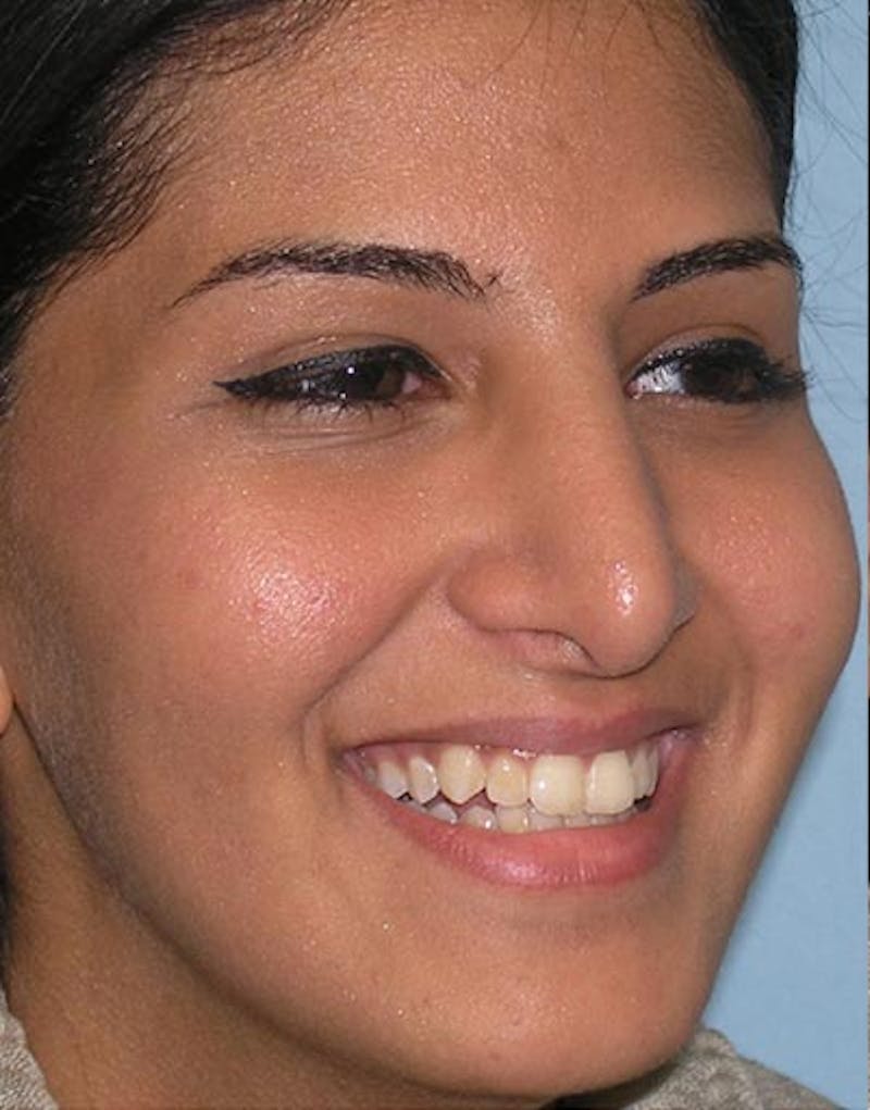 Rhinoplasty Before & After Gallery - Patient 416645 - Image 6