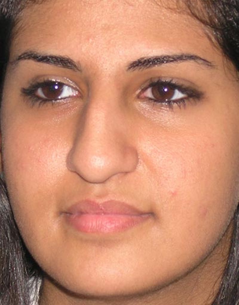 Rhinoplasty  Before & After Gallery - Patient 253779 - Image 7