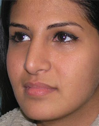 Rhinoplasty Before & After Gallery - Patient 253779 - Image 8