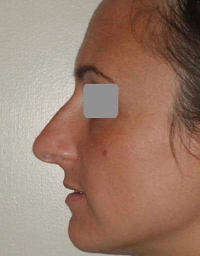 Rhinoplasty Before & After Gallery - Patient 349426 - Image 1