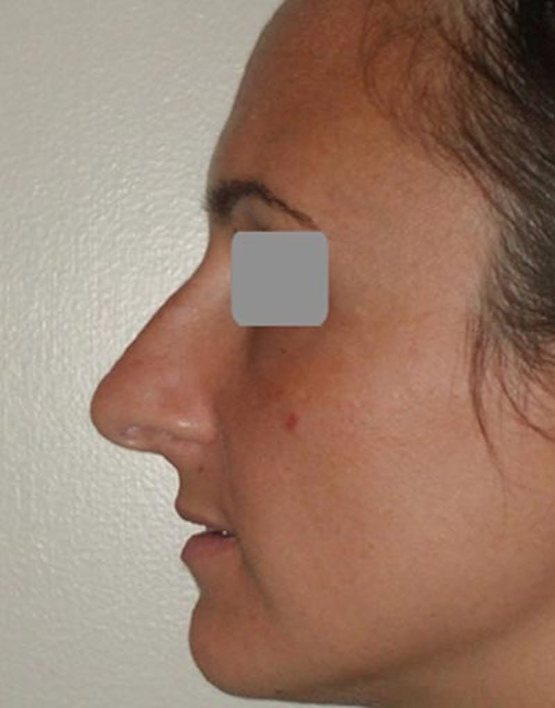 Patient WYhpri1pTeaNdR-E5RHaPA - Rhinoplasty Before & After Photos