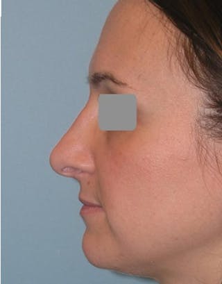 Rhinoplasty Before & After Gallery - Patient 349426 - Image 2