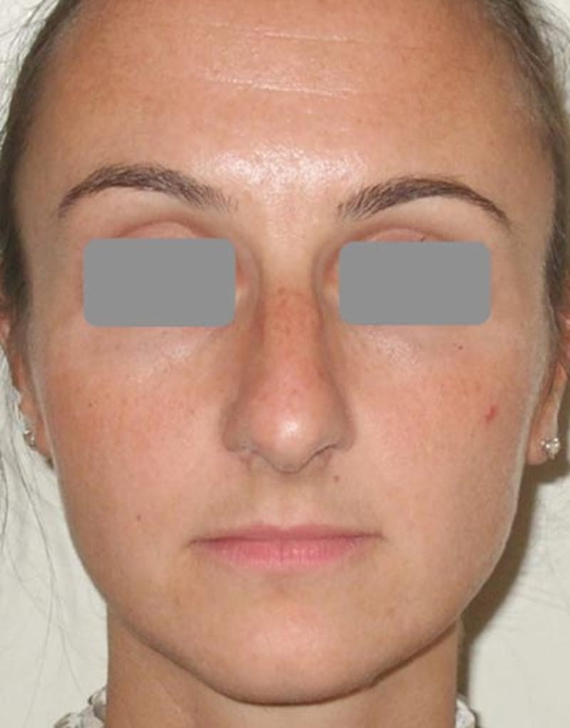 Rhinoplasty Before & After Gallery - Patient 305959 - Image 3