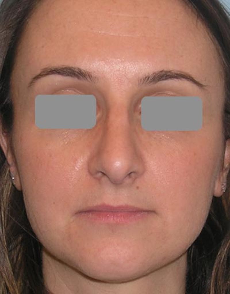 Rhinoplasty  Before & After Gallery - Patient 349426 - Image 4