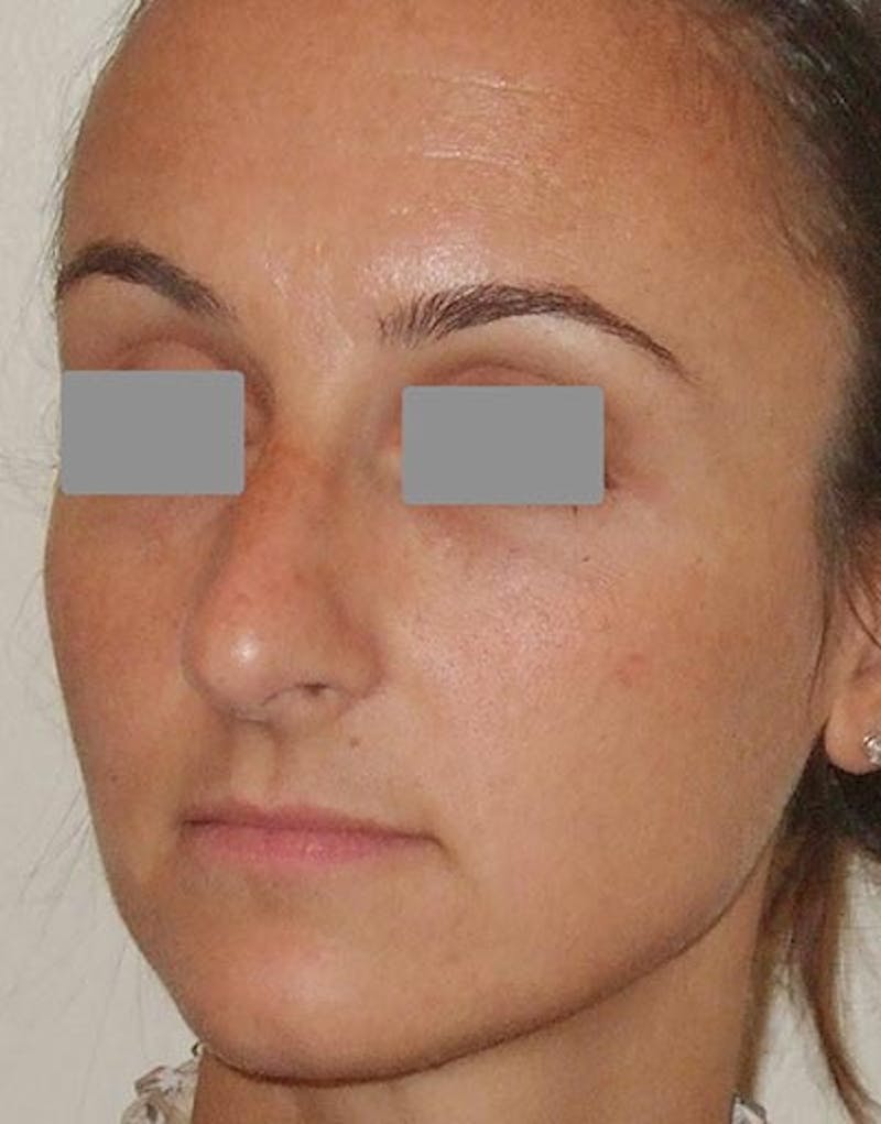 Rhinoplasty  Before & After Gallery - Patient 349426 - Image 5