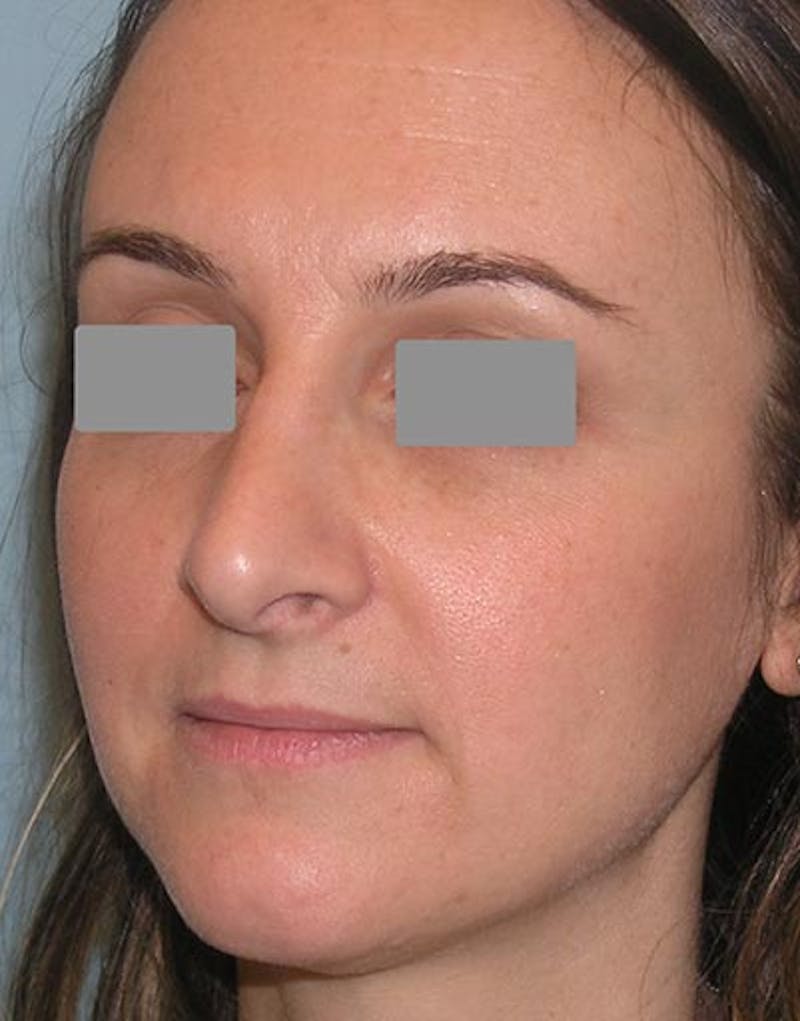 Rhinoplasty Before & After Gallery - Patient 305959 - Image 6