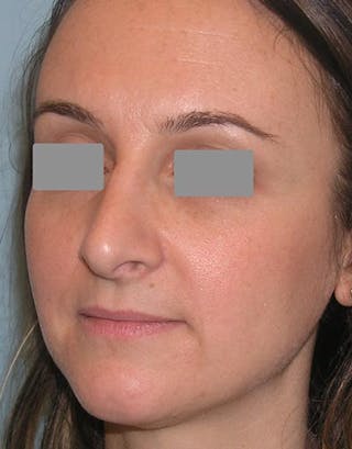 Rhinoplasty Before & After Gallery - Patient 349426 - Image 6