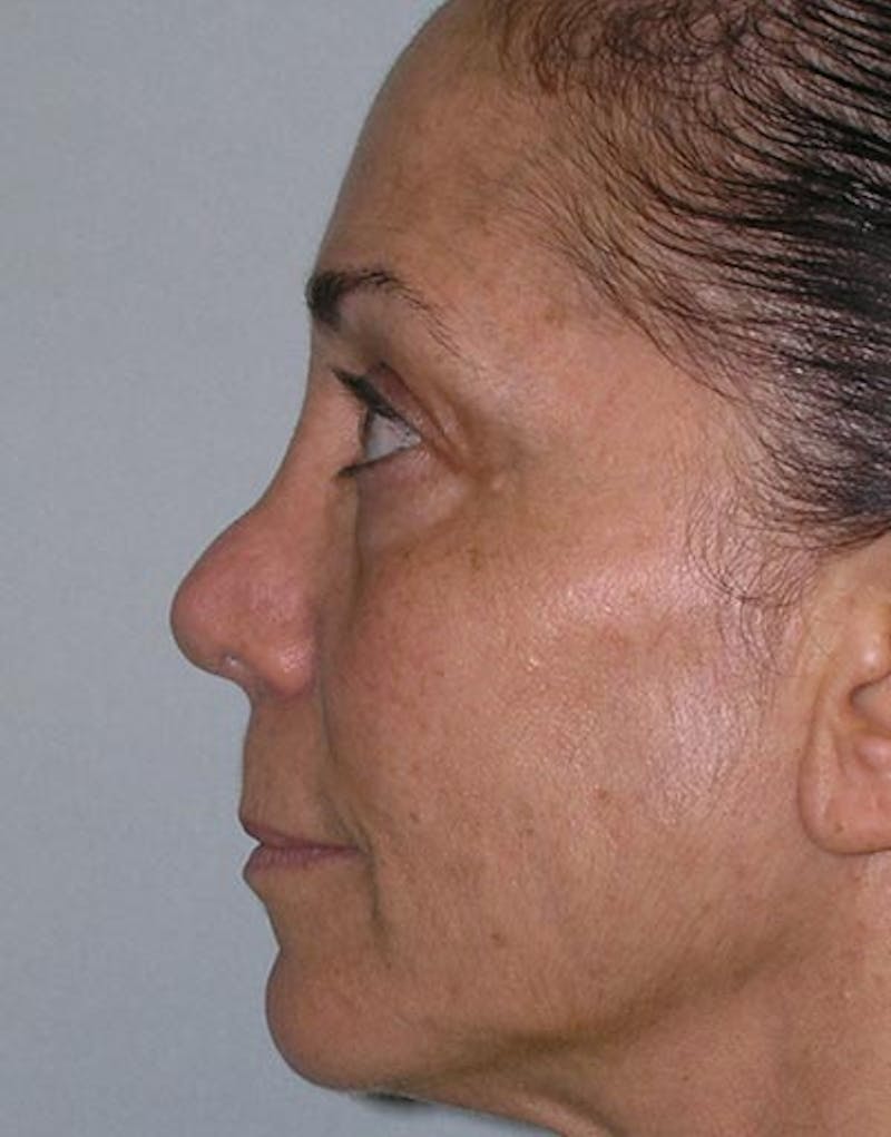 Patient OFa_AdMDR8WunQJ4335sDw - Revision Rhinoplasty Before & After Photos
