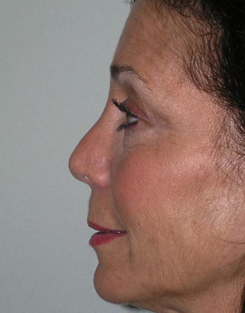 Rhinoplasty Before & After Gallery - Patient 105395 - Image 2