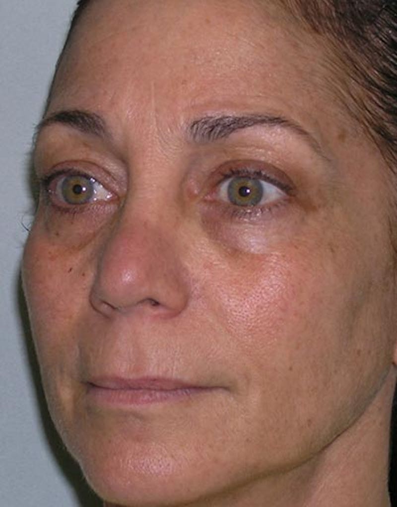 Rhinoplasty  Before & After Gallery - Patient 168926 - Image 3
