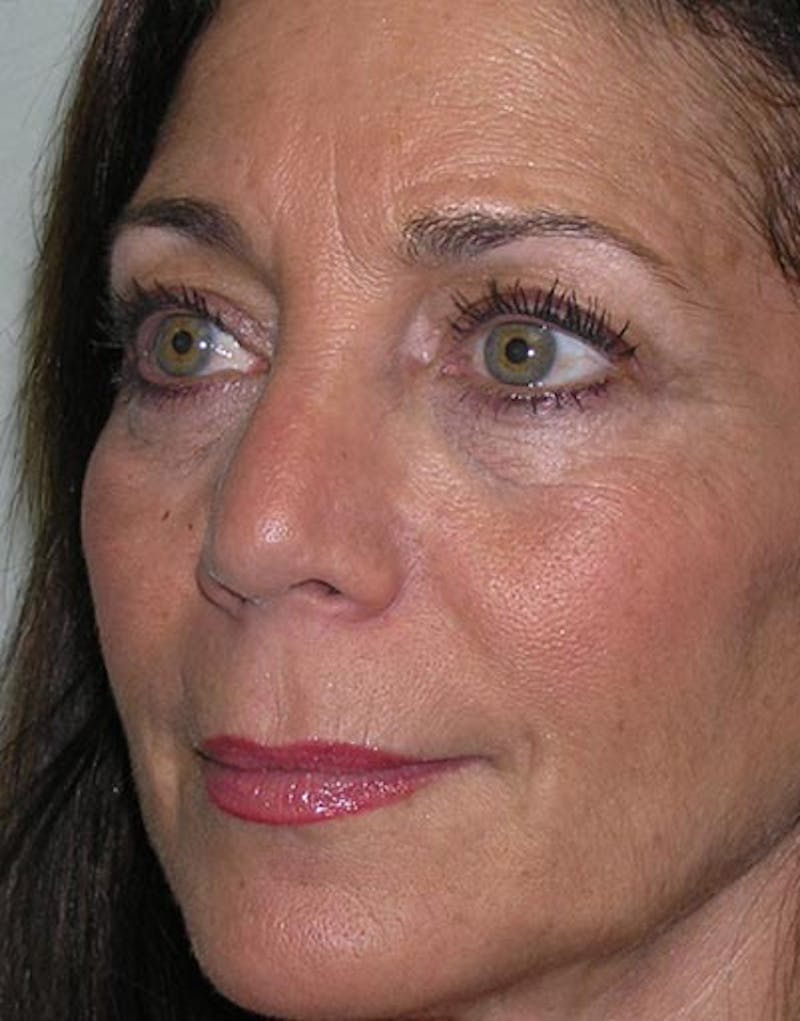 Rhinoplasty  Before & After Gallery - Patient 168926 - Image 4