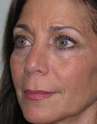 Rhinoplasty Before & After Gallery - Patient 168926 - Image 4