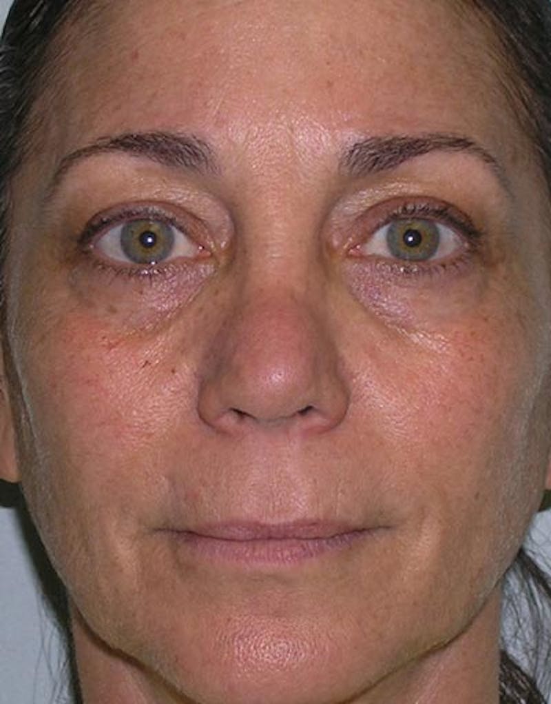 Rhinoplasty  Before & After Gallery - Patient 168926 - Image 5