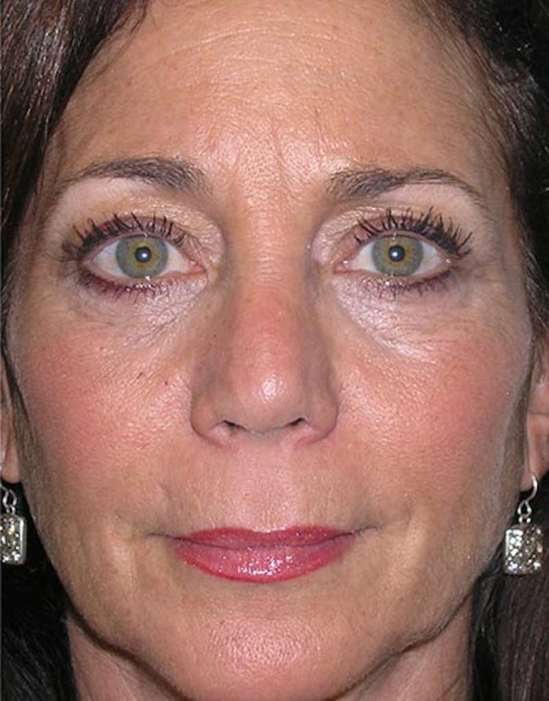 Rhinoplasty  Before & After Gallery - Patient 168926 - Image 6