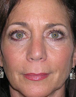 Rhinoplasty Before & After Gallery - Patient 168926 - Image 6