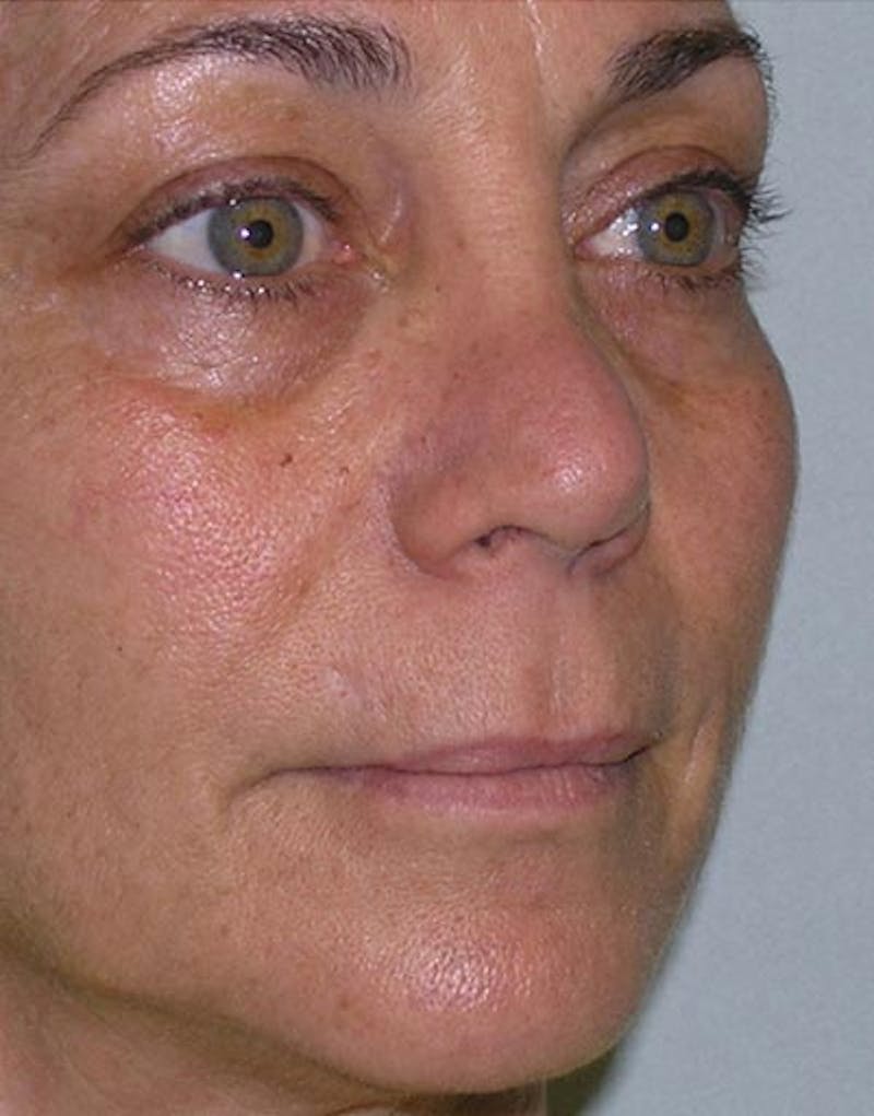 Rhinoplasty Before & After Gallery - Patient 105395 - Image 7