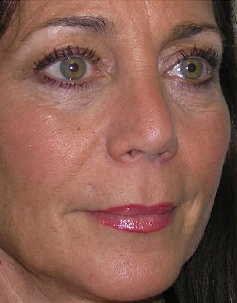Rhinoplasty  Before & After Gallery - Patient 168926 - Image 8